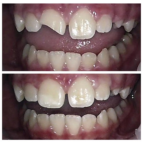 Before & After Image of Pediatric Dentistry Treatments by Dr.Mai Kamar