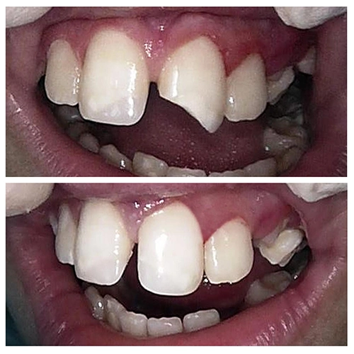 Before & After Image of Pediatric Dentistry Treatment by Dr.Mai Kamar