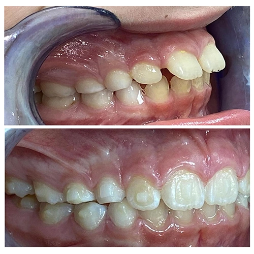 Before & After Image of Pediatric Dentistry Treatment by Dr.Mai Kamar