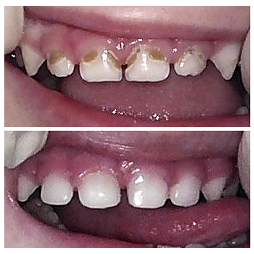 Before & After Image of Pediatric Dentistry Treatment by Dr.Mai Kamar