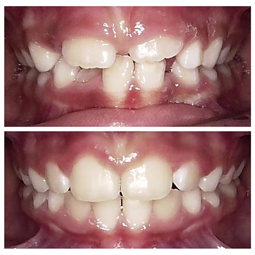 Before & After Image of Pediatric Dentistry Treatment by Dr.Mai Kamar