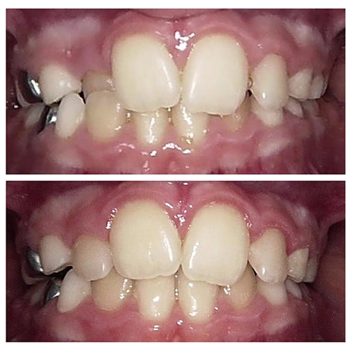 Before & After Image of Pediatric Dentistry Treatment by Dr.Mai Kamar