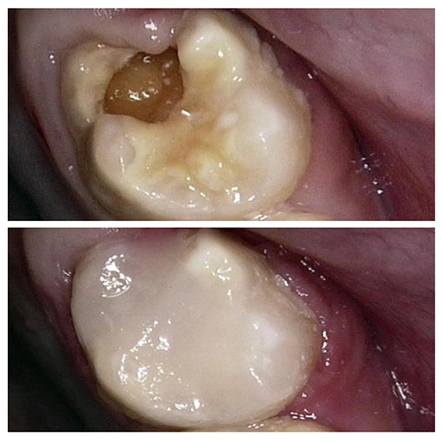 Before & After Image of Pediatric Dentistry Treatment by Dr.Mai Kamar