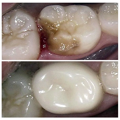 Before & After Image of Pediatric Dentistry Treatment by Dr.Mai Kamar