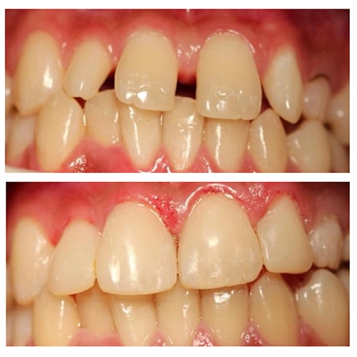 Before & After Image of Pediatric Dentistry Treatment by Dr.Mai Kamar
