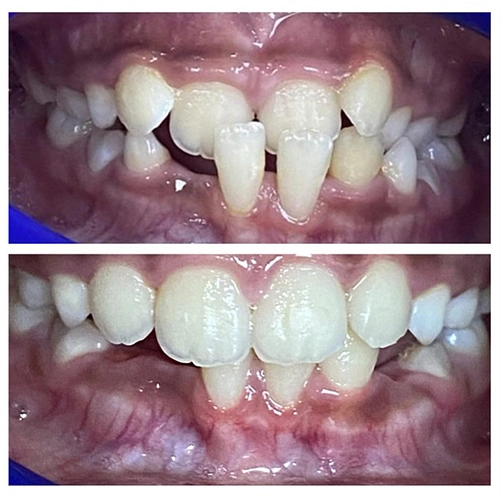 Before & After Image of Pediatric Dentistry Treatment by Dr.Mai Kamar