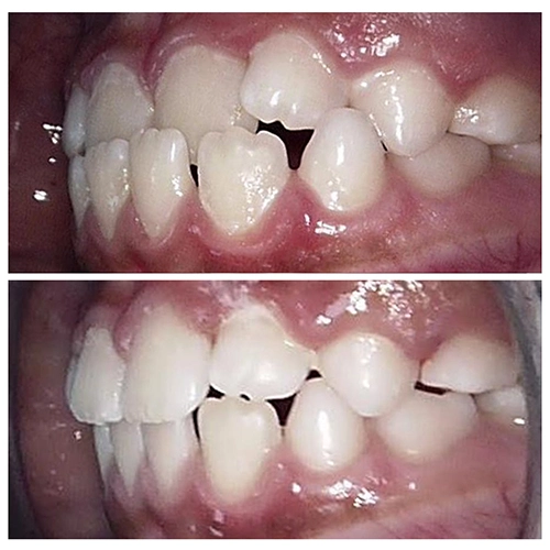Before & After Image of Pediatric Dentistry Treatment by Dr.Mai Kamar