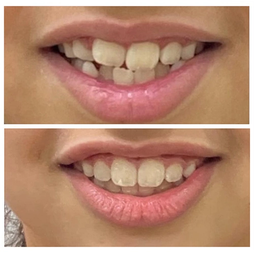Before & After Image of Pediatric Dentistry Treatment by Dr.Mai Kamar